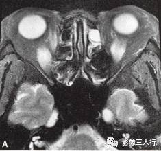 【病例】Graves眼病1例MR影像表现