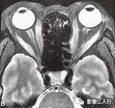 【病例】Graves眼病1例MR影像表现