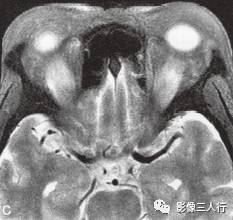 【病例】Graves眼病1例MR影像表现