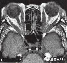 【病例】Graves眼病1例MR影像表现