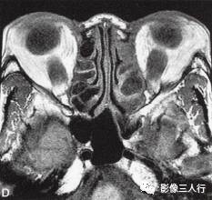 【病例】Graves眼病1例MR影像表现