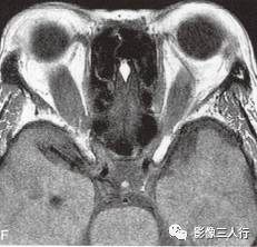 【病例】Graves眼病1例MR影像表现