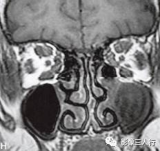 【病例】Graves眼病1例MR影像表现