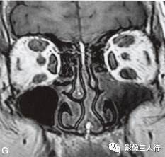 【病例】Graves眼病1例MR影像表现