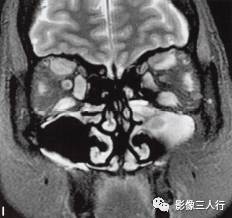 【病例】Graves眼病1例MR影像表现
