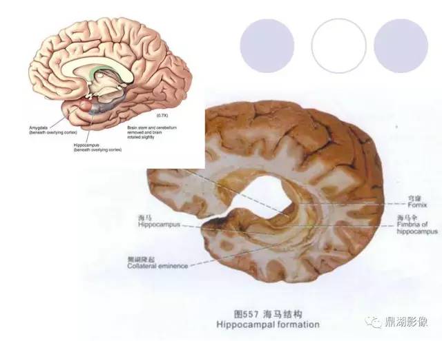 【PPT】海马硬化性颞叶癫痫的MRI探索研究