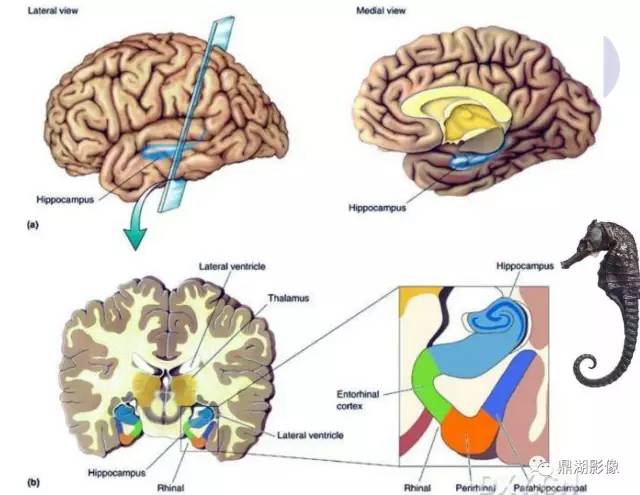 【PPT】海马硬化性颞叶癫痫的MRI探索研究