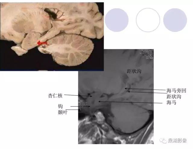 【PPT】海马硬化性颞叶癫痫的MRI探索研究