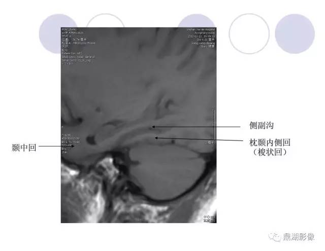 【PPT】海马硬化性颞叶癫痫的MRI探索研究