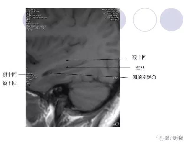 【PPT】海马硬化性颞叶癫痫的MRI探索研究