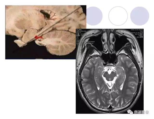 【PPT】海马硬化性颞叶癫痫的MRI探索研究