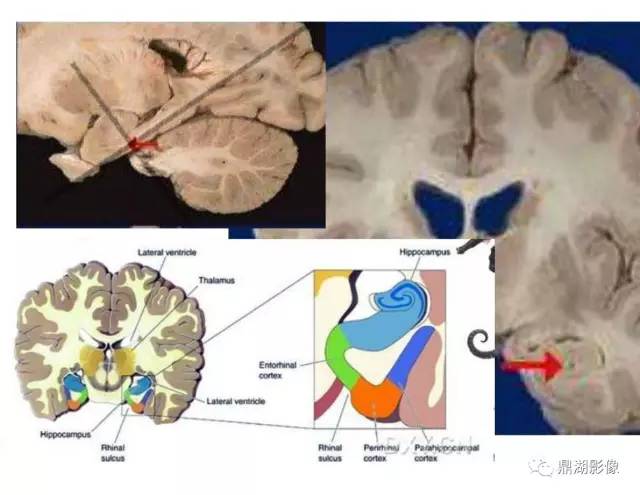 【PPT】海马硬化性颞叶癫痫的MRI探索研究