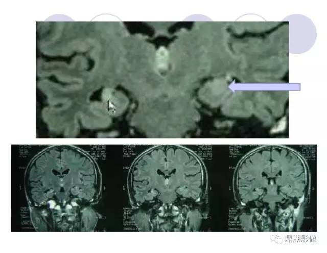 【PPT】海马硬化性颞叶癫痫的MRI探索研究