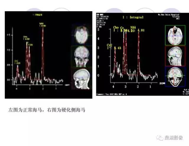 【PPT】海马硬化性颞叶癫痫的MRI探索研究