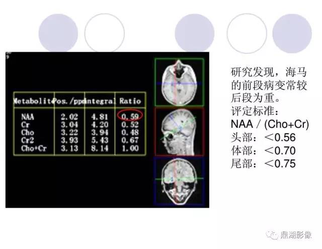 【PPT】海马硬化性颞叶癫痫的MRI探索研究