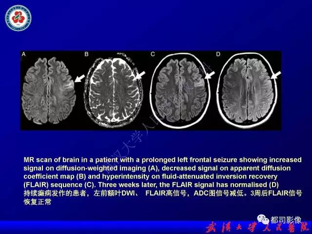 【PPT】皮层异常信号病变MRI诊断