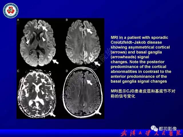 【PPT】皮层异常信号病变MRI诊断