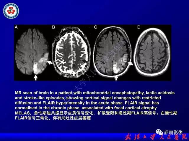 【PPT】皮层异常信号病变MRI诊断