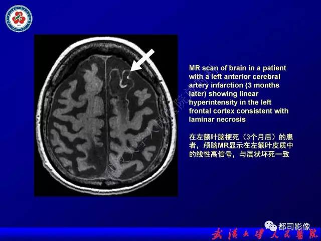 【PPT】皮层异常信号病变MRI诊断