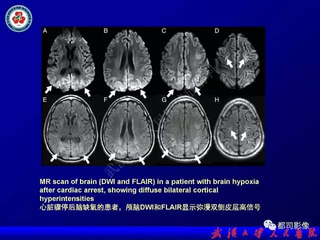 【PPT】皮层异常信号病变MRI诊断