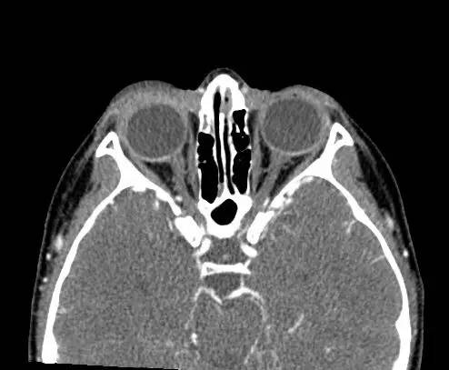 【病例】右上眼睑和眼球间木片存留1例CT影像表现