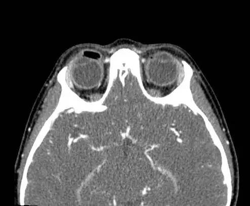 【病例】右上眼睑和眼球间木片存留1例CT影像表现