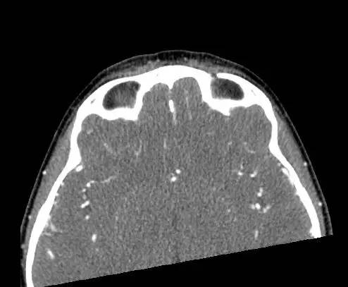 【病例】右上眼睑和眼球间木片存留1例CT影像表现