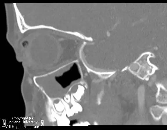 【病例】右上眼睑和眼球间木片存留1例CT影像表现