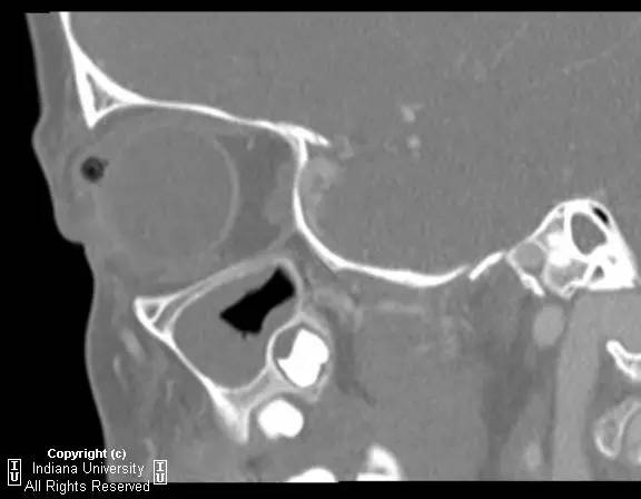 【病例】右上眼睑和眼球间木片存留1例CT影像表现