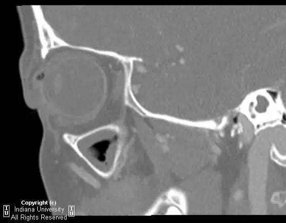 【病例】右上眼睑和眼球间木片存留1例CT影像表现
