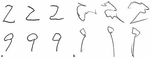 【病例】静脉窦血栓导致阵发性震颤1例MR