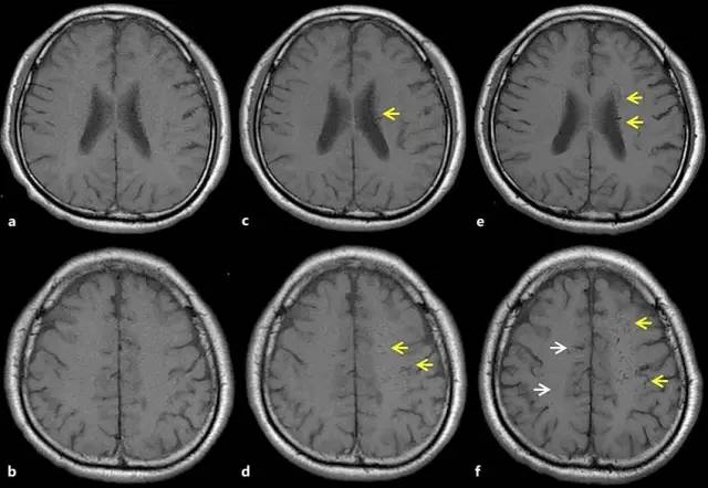 【病例】静脉窦血栓导致阵发性震颤1例MR