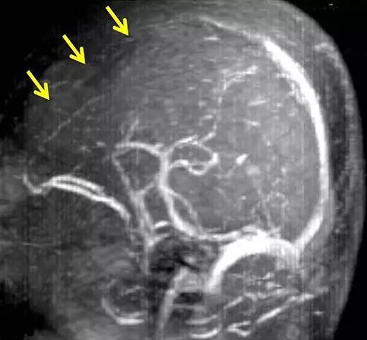 【病例】静脉窦血栓导致阵发性震颤1例MR