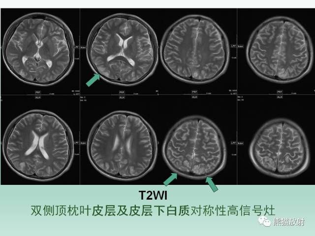 【PPT】可逆性后部脑病综合征