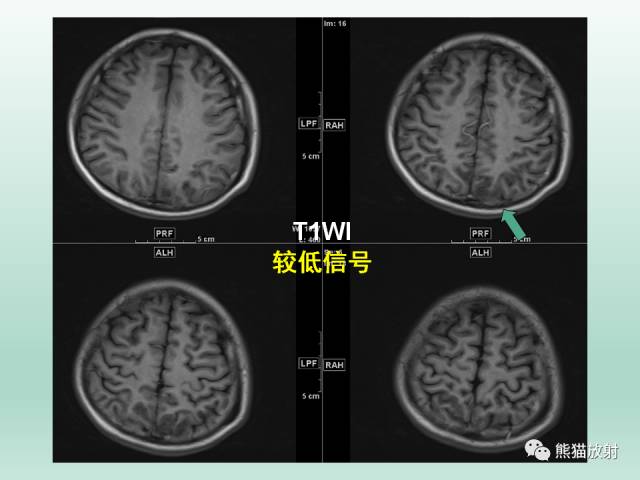 【PPT】可逆性后部脑病综合征