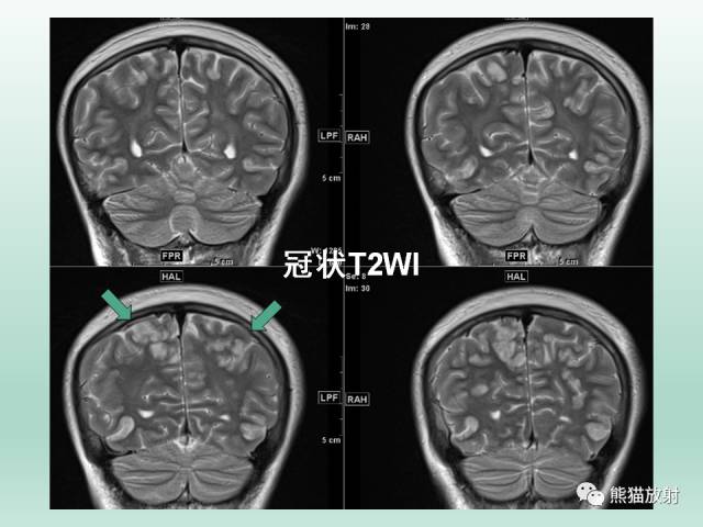 【PPT】可逆性后部脑病综合征