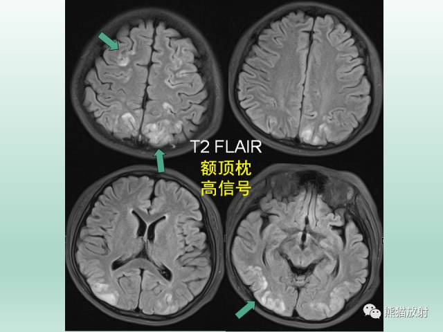 【PPT】可逆性后部脑病综合征