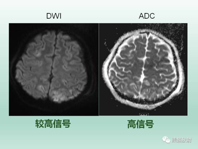 【PPT】可逆性后部脑病综合征