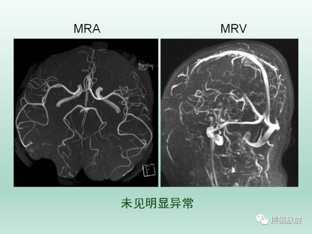 【PPT】可逆性后部脑病综合征