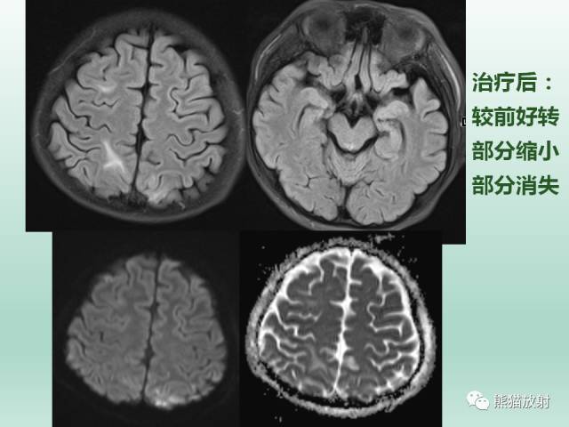 【PPT】可逆性后部脑病综合征