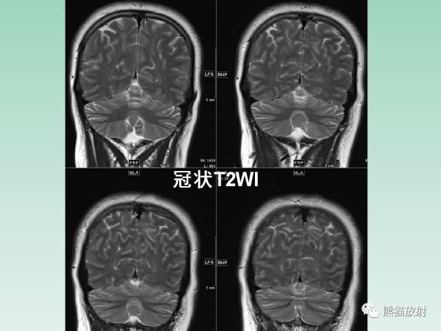 【PPT】可逆性后部脑病综合征