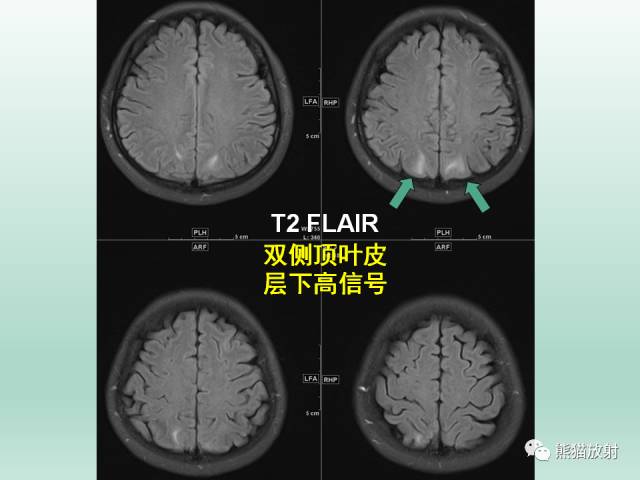 【PPT】可逆性后部脑病综合征