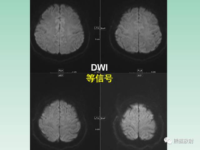 【PPT】可逆性后部脑病综合征