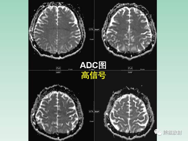 【PPT】可逆性后部脑病综合征
