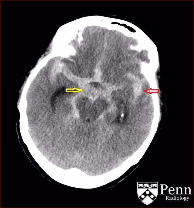 【病例】动脉瘤性蛛网膜下腔出血1例 【病例】动脉瘤性蛛网膜下腔出血1例