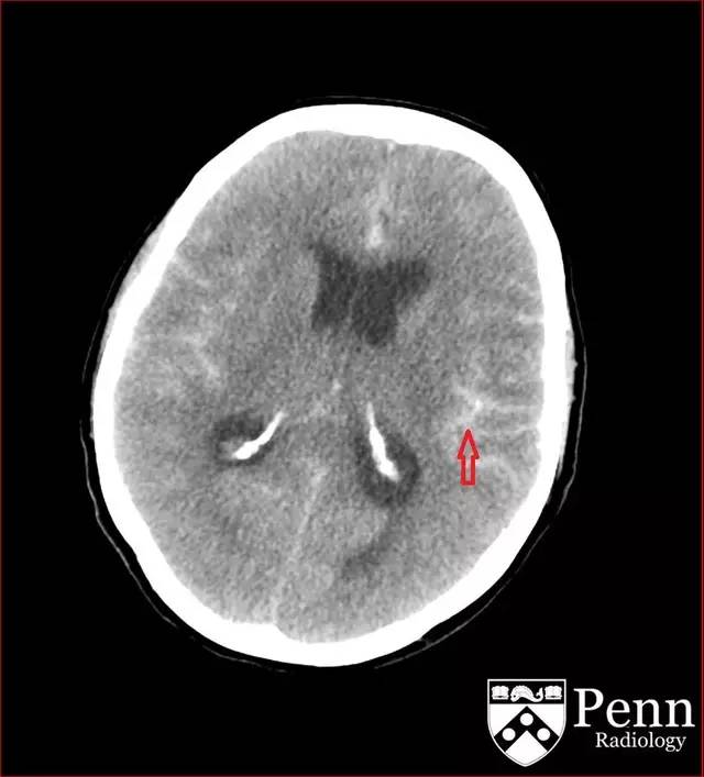 【病例】动脉瘤性蛛网膜下腔出血1例 【病例】动脉瘤性蛛网膜下腔出血1例