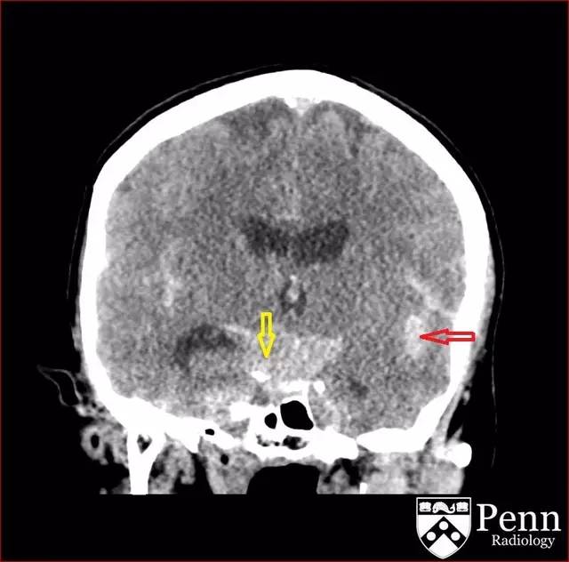 【病例】动脉瘤性蛛网膜下腔出血1例 【病例】动脉瘤性蛛网膜下腔出血1例