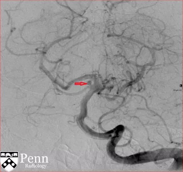 【病例】动脉瘤性蛛网膜下腔出血1例 【病例】动脉瘤性蛛网膜下腔出血1例