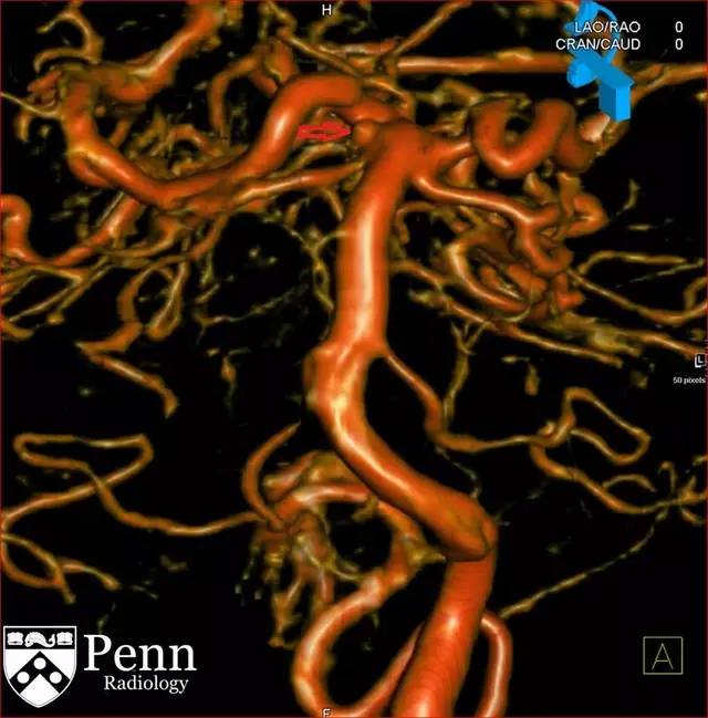【病例】动脉瘤性蛛网膜下腔出血1例 【病例】动脉瘤性蛛网膜下腔出血1例