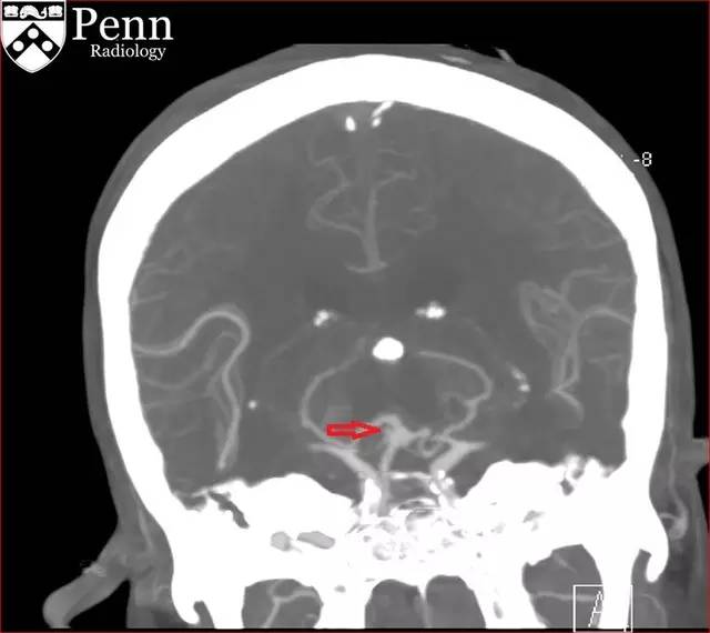 【病例】动脉瘤性蛛网膜下腔出血1例 【病例】动脉瘤性蛛网膜下腔出血1例